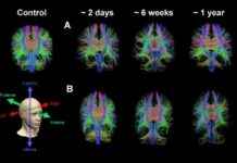 Advanced MRI for Concussion Detection: Uncovering Hidden Injuries news-09082024-103413