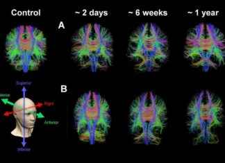 Advanced MRI for Concussion Detection: Uncovering Hidden Injuries news-09082024-103413
