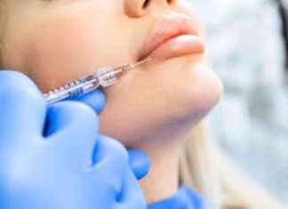 Warning: Beauty Fan Shares Scary Experience with Lip Filler Result news-09082024-110943