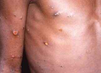 Global Emergency declared by World Health Organisation: What you need to know news-15082024-112532